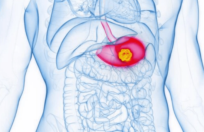 pancreatic cancer interception